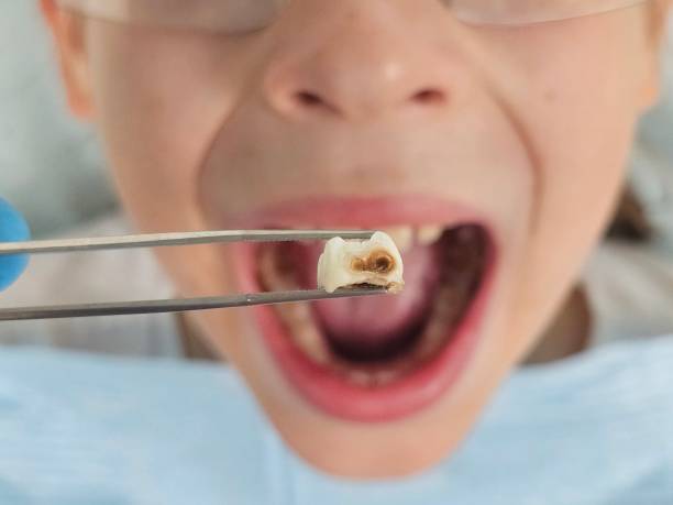 Best Emergency Treatment for Oral Infections in Toledo, OR
